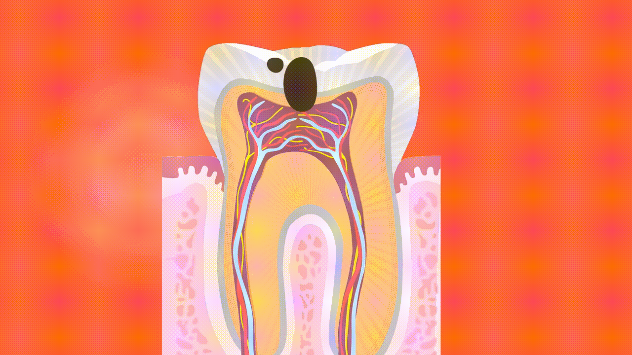 Endodoncia en Puebla