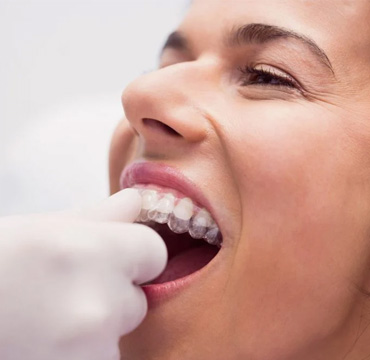 Alineadores Invisibles