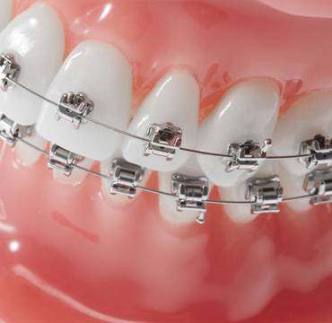 Brackets Baja Fricción