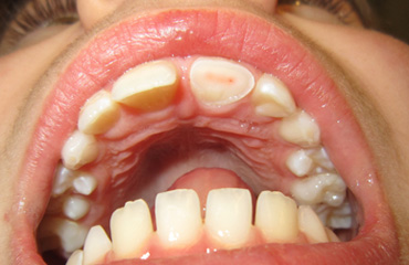 Check Up Dental en Puebla