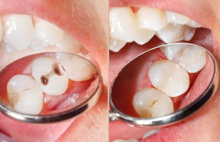 Servicios de Prevención Dental en Puebla