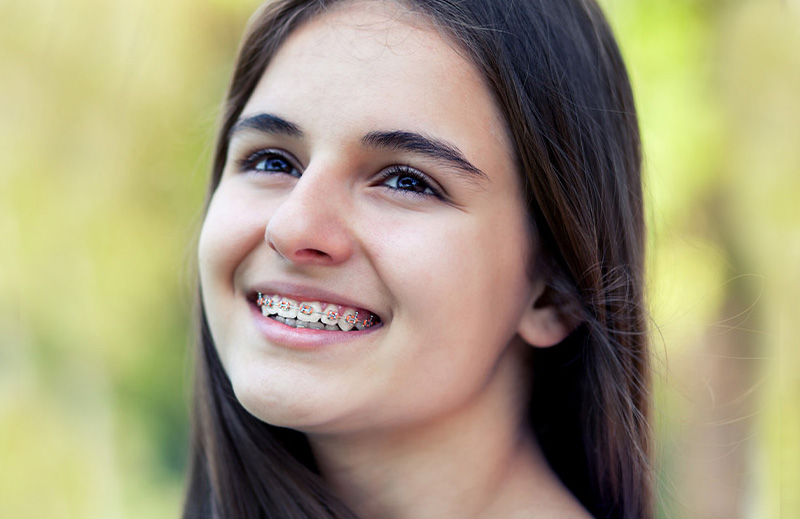 Aplicación de Brackets Estéticos Autoligado Baja Fricción en Puebla