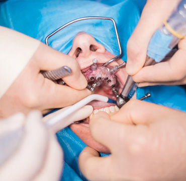 Cirugías Dentales en Puebla