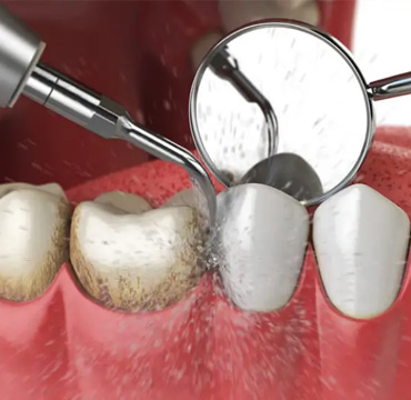 Periodoncia en Puebla