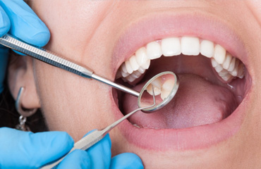 Tratamientos de Endodoncia en Puebla