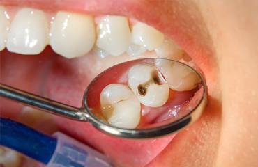 Diseño de Prótesis Dentales en Puebla