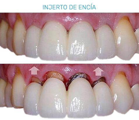 Tratamientos de Periodoncia en Puebla