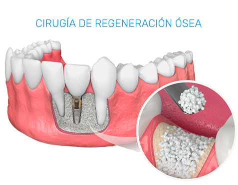 Tratamientos de Periodoncia en Puebla
