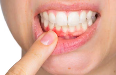 Tratamientos de Periodoncia en Puebla