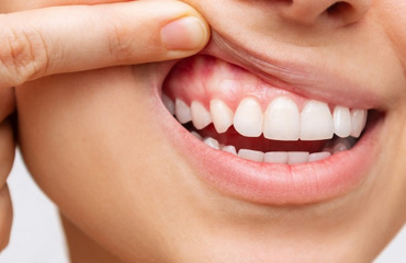 Tratamientos de Periodoncia en Puebla