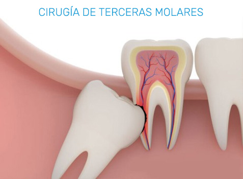 Cirugías de Especialidad Dental en Puebla
