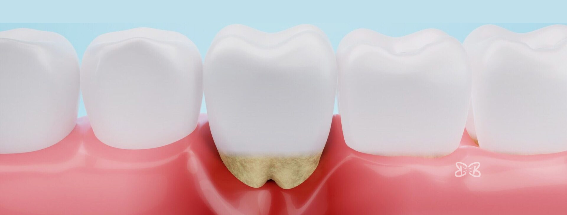 Tratamientos de Periodoncia en Puebla