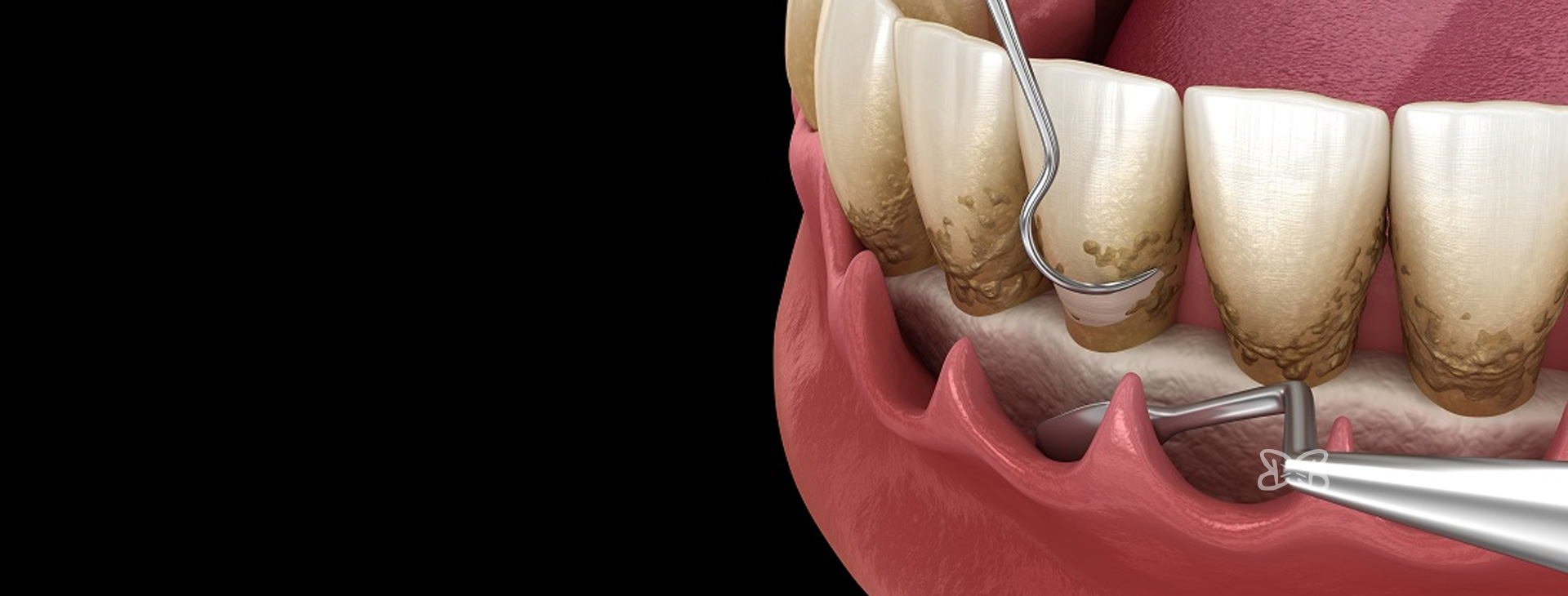 Tratamientos de Periodoncia en Puebla