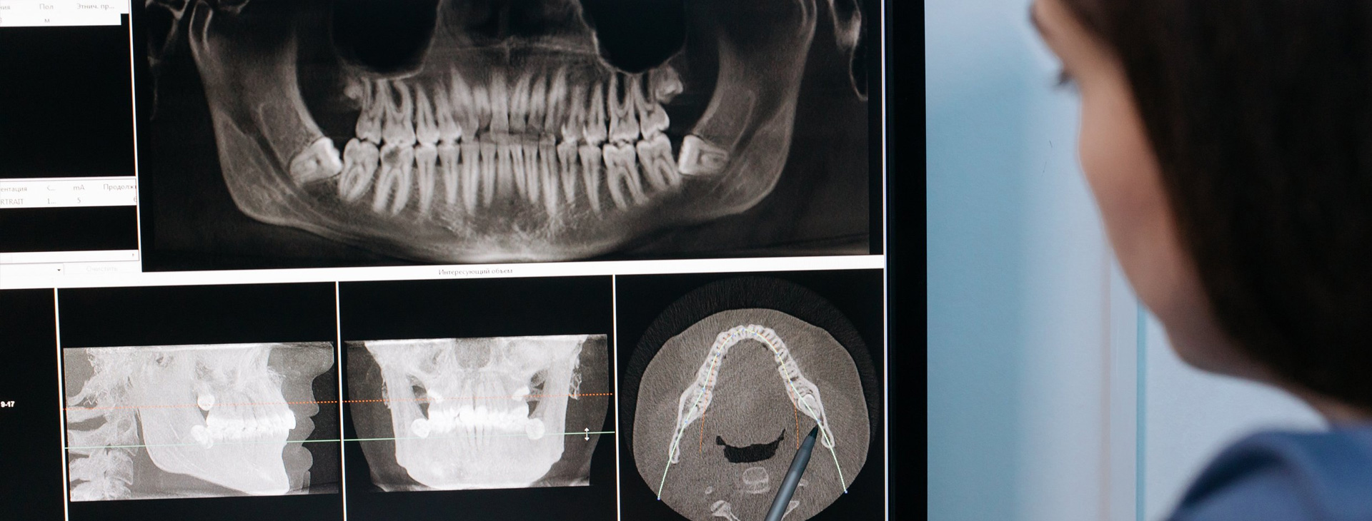 Rayos X Dentales Digitales en Puebla